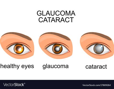 Healthy Eyes Glaucoma Cataracts Royalty Free Vector Image