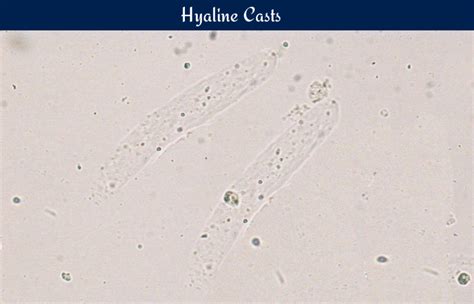 Hyaline Casts In Urine Morphology And Clinical Significance