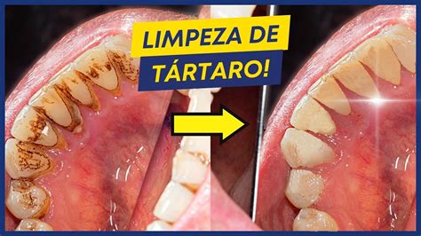 Como Feita A Limpeza De T Rtaro Youtube