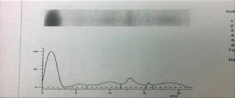 Serum protein electrophoresis (Normal control) | Download Scientific ...