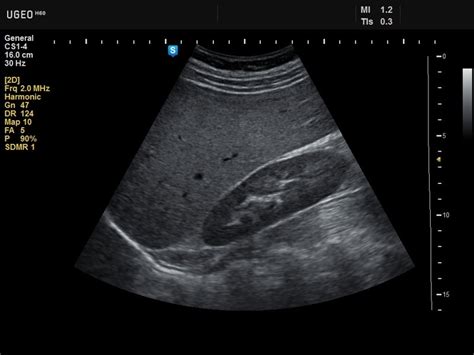 Ultrasound images • Kidney, B-mode, echogramm №636