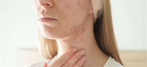 Cystic Acne Treatment Symptoms And Causes Dr Axe