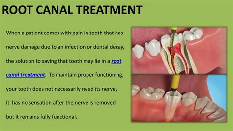 Ppt Tips To Follow After Root Canal Treatment Powerpoint Presentation