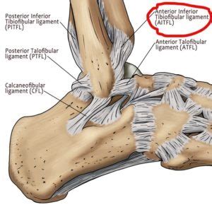 What is a High Ankle Sprain? - MyAnkle Ankle Surgeon London