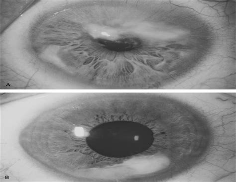 Salzmann S Nodular Degeneration Of The Cornea A Review And Cornea