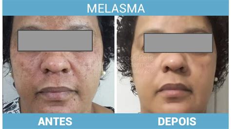 Flebon Melasma Antes E Depois - Melasma - Veja O Antes E Depois Dos Tratamentos Mais Eficazes - O ...