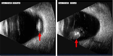 Frontiers Case Report Spontaneous Bilateral Intraocular Lens