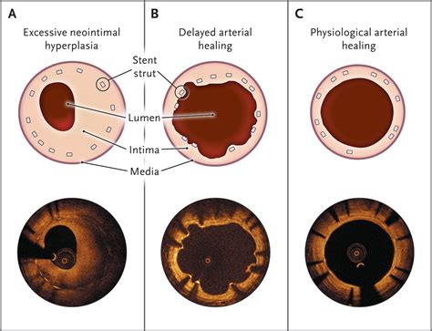 Drug Eluting Coronary Artery Stents NEJM