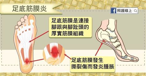 剛走路腳痛、多走幾步就改善？你可能罹患「足底筋膜炎」｜骨科．復健｜科別｜元氣網