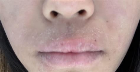 Flaky And Dry Skin Above Lip Rskincareaddicts