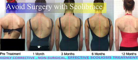 Scoliosis Treatment Vancouver Chiropractic Dr Kenny Chan