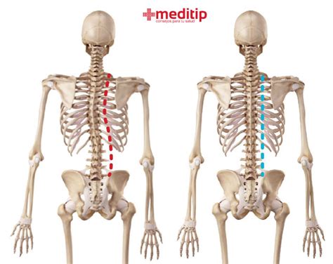 Desviación De La Columna Qué Es Normal Y Qué Es Escoliosis Meditip