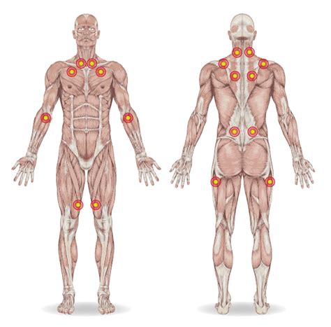 Fibromyalgie Symptomen Oorzaak Behandeling