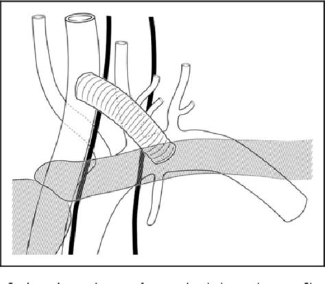 Carotid Subclavian Bypass