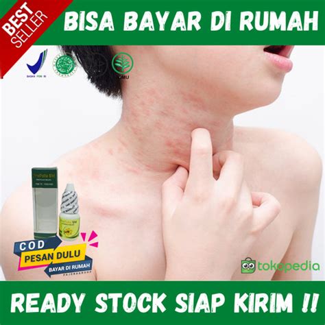 Promo Obat Miliaria Rubra Obat Biang Keringat Anak Dewasa Gatal