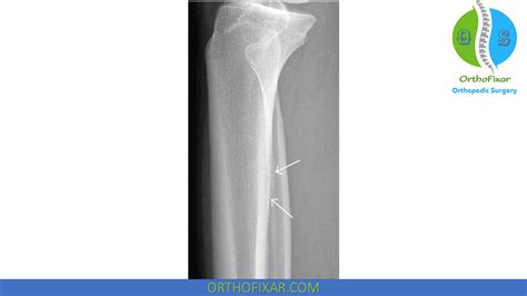 Tibial Stress Fracture Orthofixar 2025