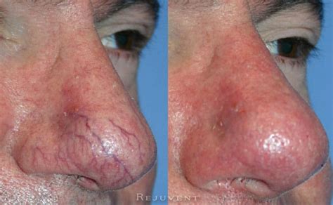 Veinwave Removes Facial Veins Rejuvent Medical Spa Scottsdale