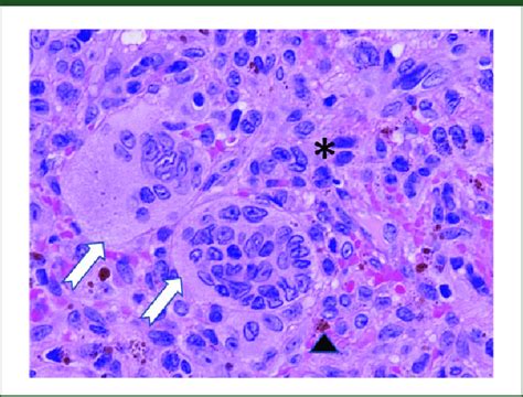 Pathohistology Demonstrating Giant Cell Tumour Of Bone Composed Of