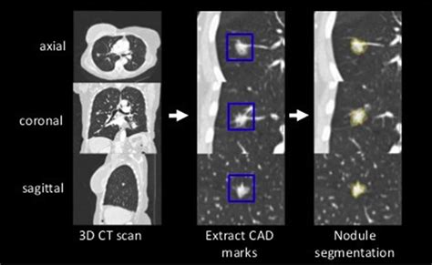 A Review Of Lung Cancer Screening And The Role Of Computer Aided Detection Clinical Radiology