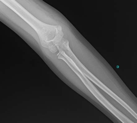 Supracondylar Fracture Gartland Type Ii Image Radiopaedia Org