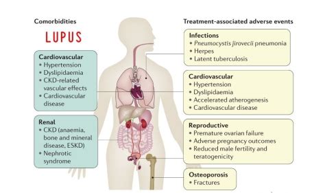 Infographic: Causes And Treatments Of Lupus | Doctors Without Waiting Rooms