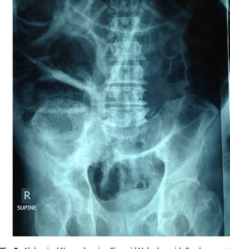 Figure 5 From The Steel Pan Sign Of Sigmoid Volvulus—a Case Series