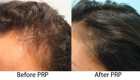 Prp Hair Regrowth Treatment Client 1 Sure Hair Transplants Toronto Ontario Canada