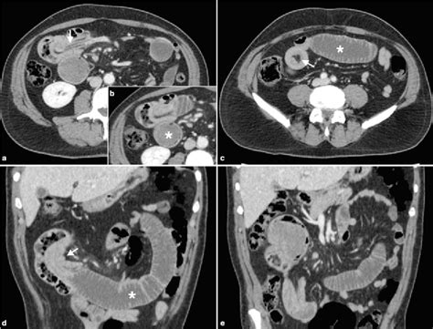 Figure 1 From Ileo Ileal Intussusception Caused By Primary Monophasic Synovial Sarcoma Ss Of