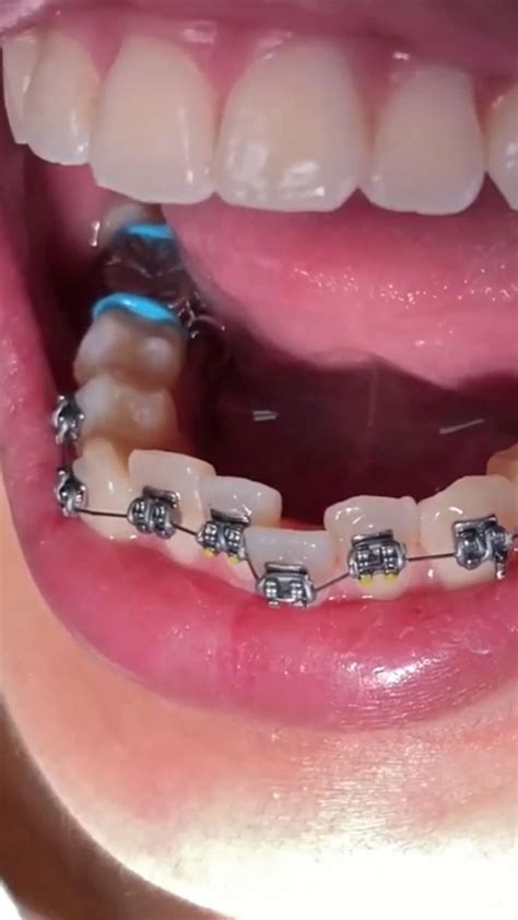 Amazing Braces Transformation [video] Getting Braces Braces