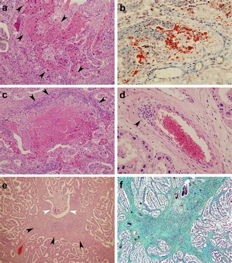 High Rate Of Transplacental Infection And Transmission Of Neospora