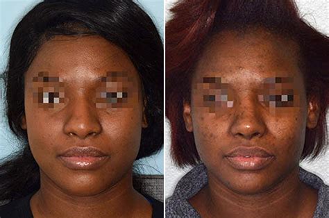 African American Rhinoplasty In Miami Fl Dr Anthony Bared