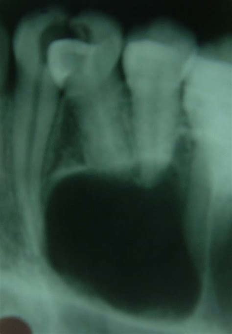 Radiograph Showing Large Well Defined Periapical Radiolucency In