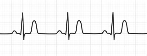 Acute Myocardial Infarction On Ecg Ecg Disease Patterns Medschool