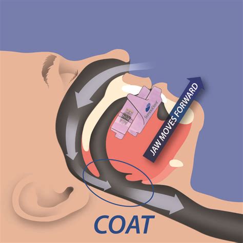 Dental Appliances For Sleep Apnea And Treatment Sleep Apnea Treatment