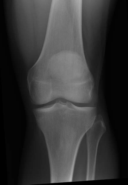 Xray Knee