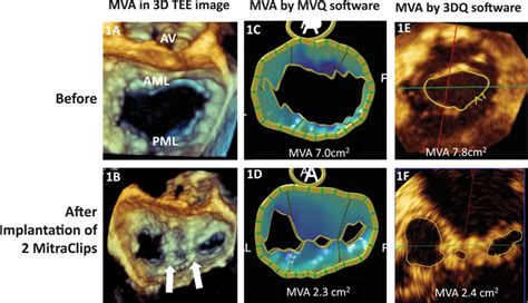 Assessment Of Mitral Valve Area During Percutaneous Mitral Valve Repair