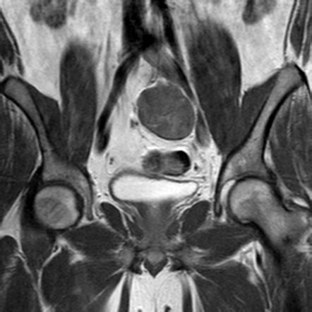 Pelvic Schwannoma Image Radiopaedia Org