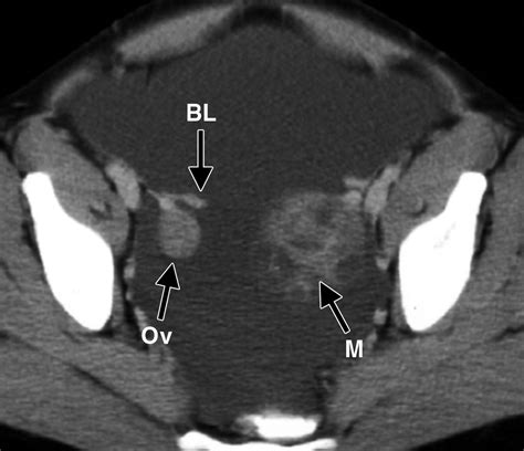 Recognition Of The Ovaries And Ovarian Origin Of Pelvic Masses With Ct