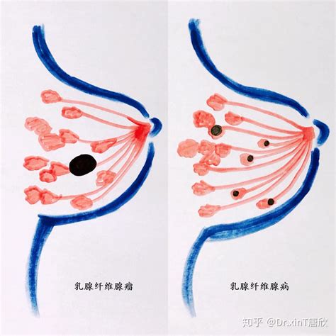 乳腺纤维腺瘤 乳腺纤维腺病？ 知乎