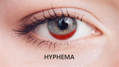 Hyphema Causes Symptoms Diagnosis And Treatment Specscart