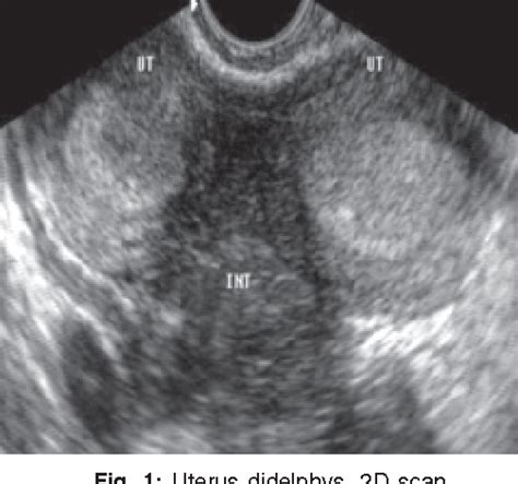 Didelphys Uterus Ultrasound