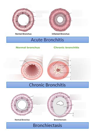 Acute bronchitis, chronic bronchitis, bronchiectasis- labelled ...