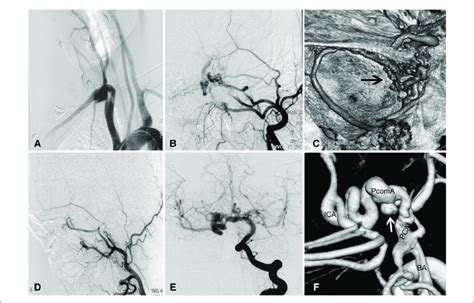 Complicated aneurysm of the posterior communicating artery with ...