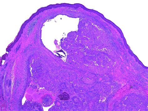 Pathology Walker@Auto Tweet Bot on Twitter: "Hidradenoma. #Pathology # ...