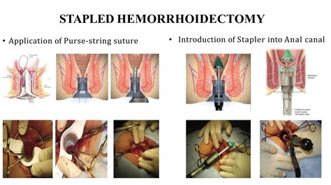 Hemorrhoidectomy Surgical Procedure Raf Pptx