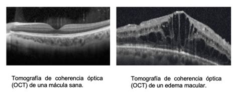 Brolucizumab Nuevo Tratamiento Para El Edema Macular Diab Tico