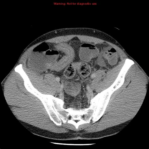 Crohns Terminal Ileitis And Sacroiliitis Image