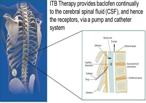 Intrathecal Baclofen Pumps What The Neurologist Needs To Know