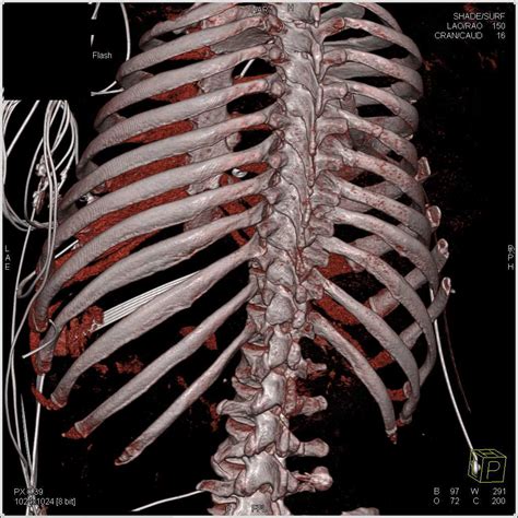 Chest X Ray Showing A Narrowed Chest And Multiple Rib Fractures Sexiz Pix