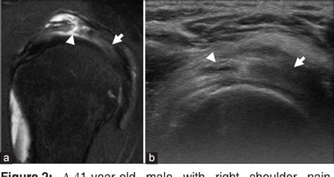 Figure 1 From Accuracy Of Rotator Cuff Tears And Tendinosis Diagnoses On Shoulder Ultrasound